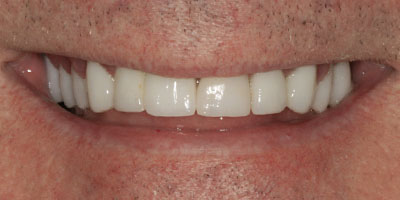 Before & After: Complete Denture After