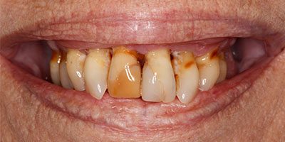 Before & After: Complete Denture With Extractions Before