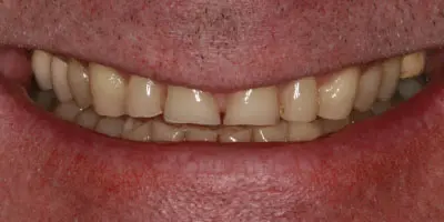 Before: complete denture
