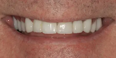 After: complete denture