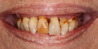 Before: complete denture with extractions
