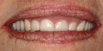After: complete denture with extractions