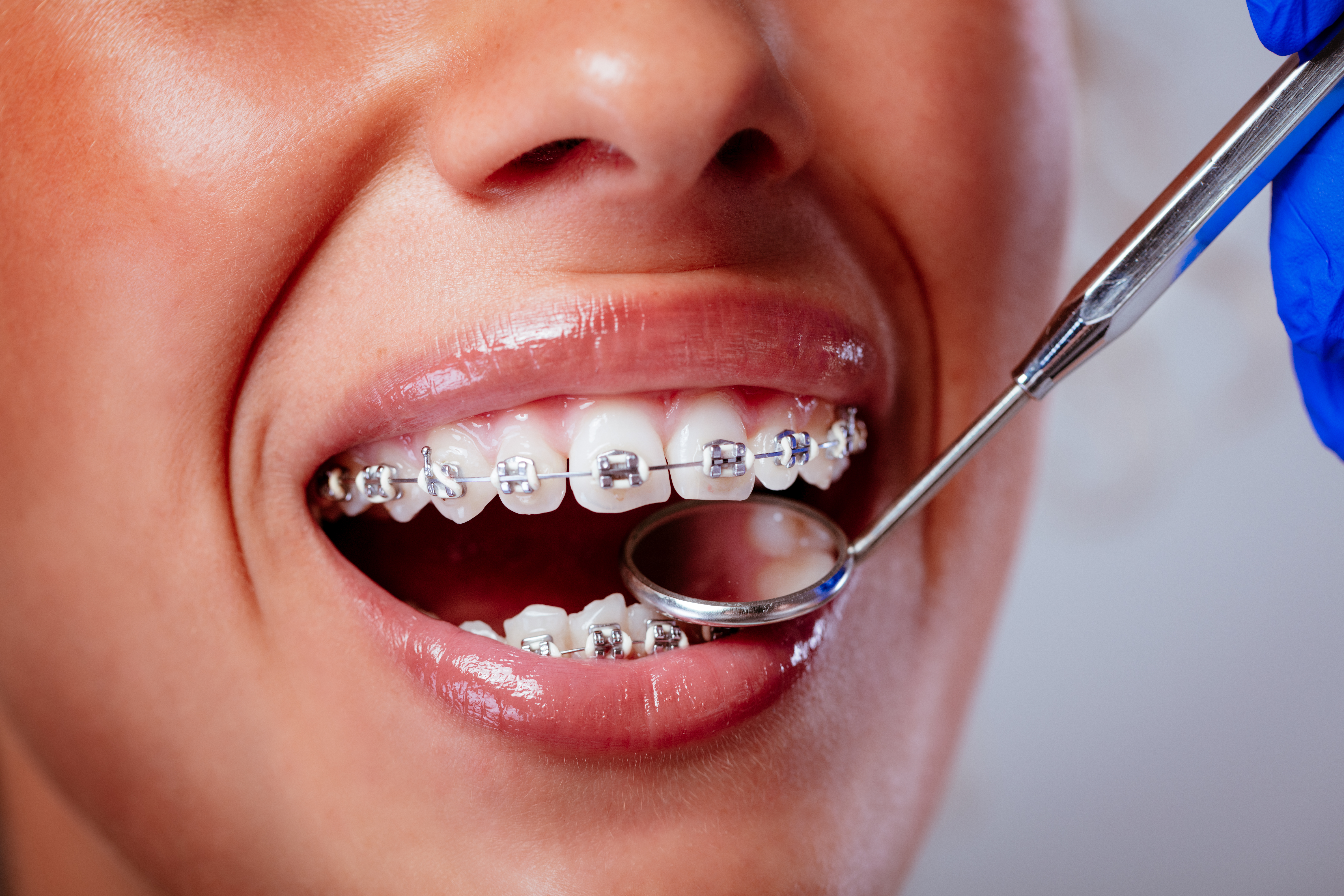 Clear Braces Near Downtown Lake City: What to Expect