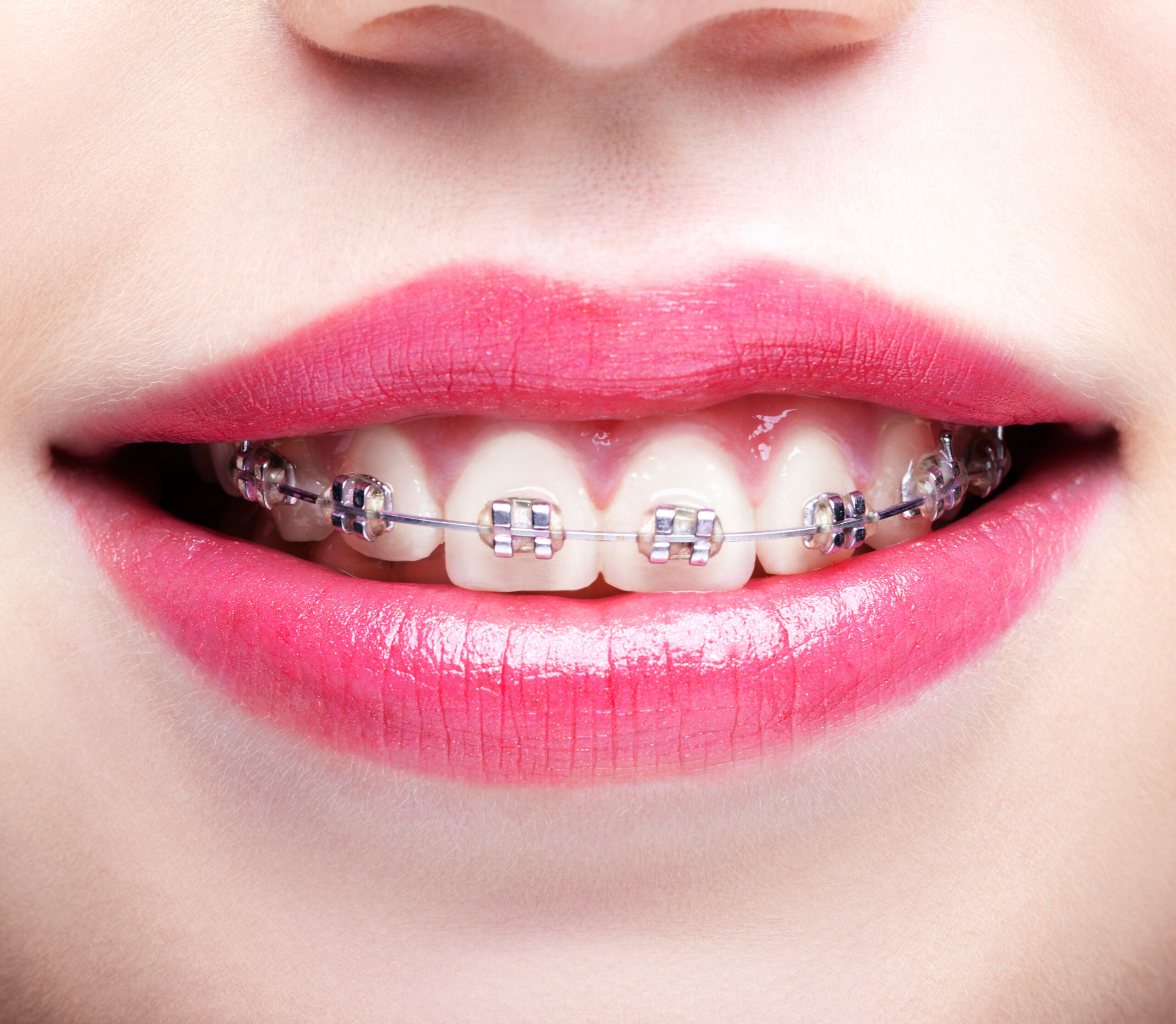 Dental Braces